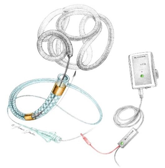 Barricade - Embolization Coil System